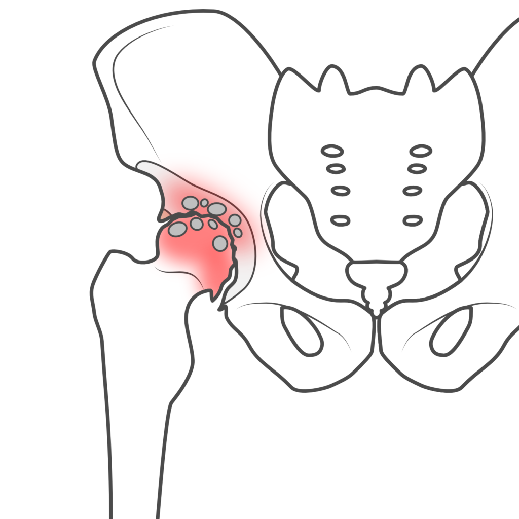 変形性股関節症イメージ図